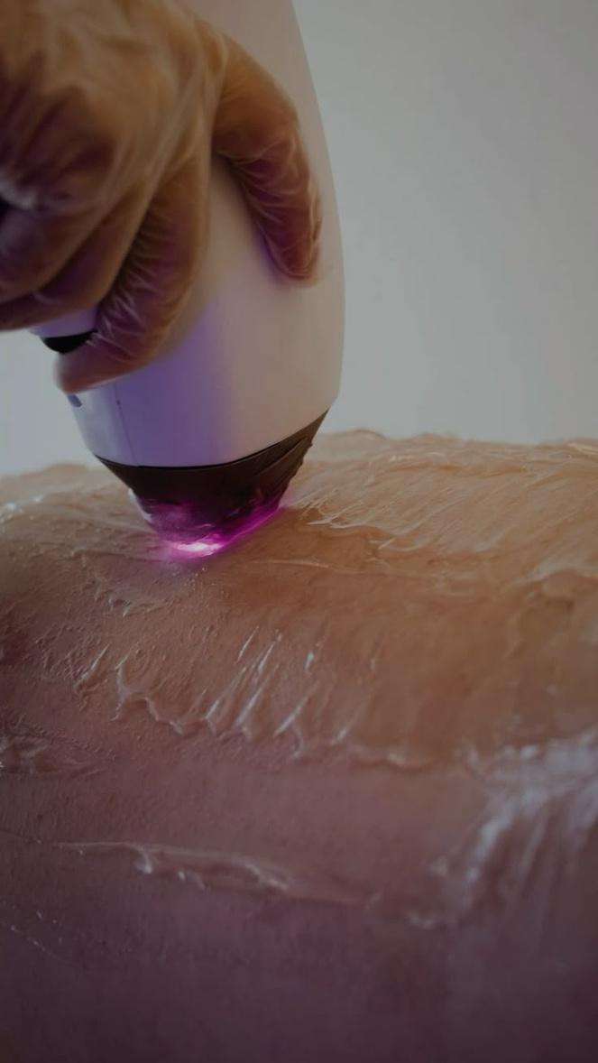 Épilation laser diode au centre de bien-être