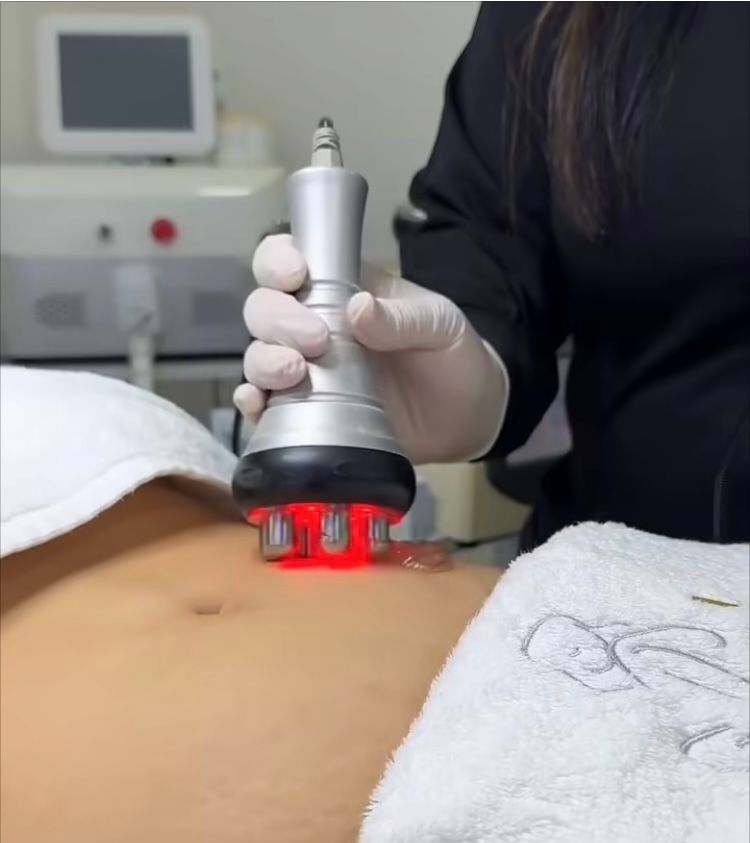 Séance de lipocavitation et radiofréquence sur l'abdomen
